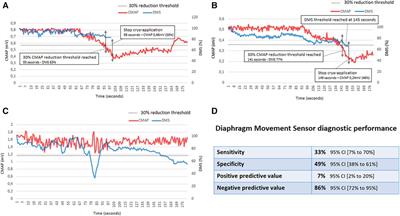 Diaphragm movement sensor for phrenic nerve monitoring during cryoballoon procedures: the first clinical evaluation